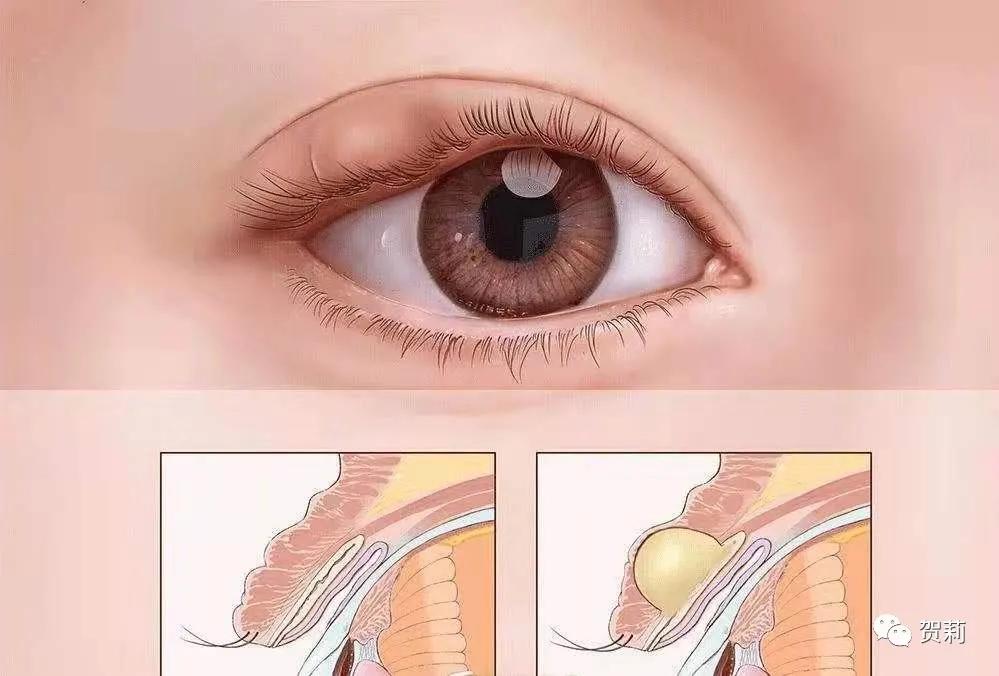 睑板腺囊肿眼皮图片,睑板腺囊肿眼皮肿怎么办