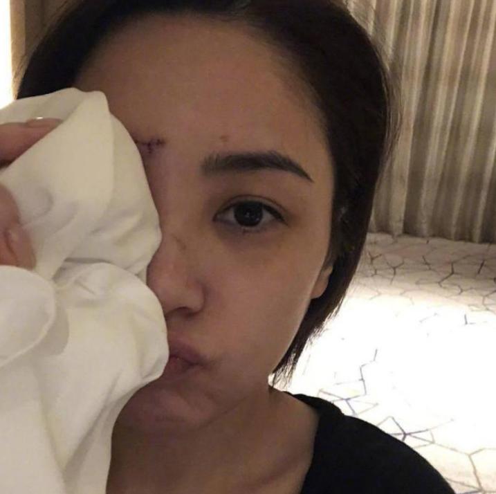 阿娇伤后首露面图片,阿娇晒出额头受伤照片
