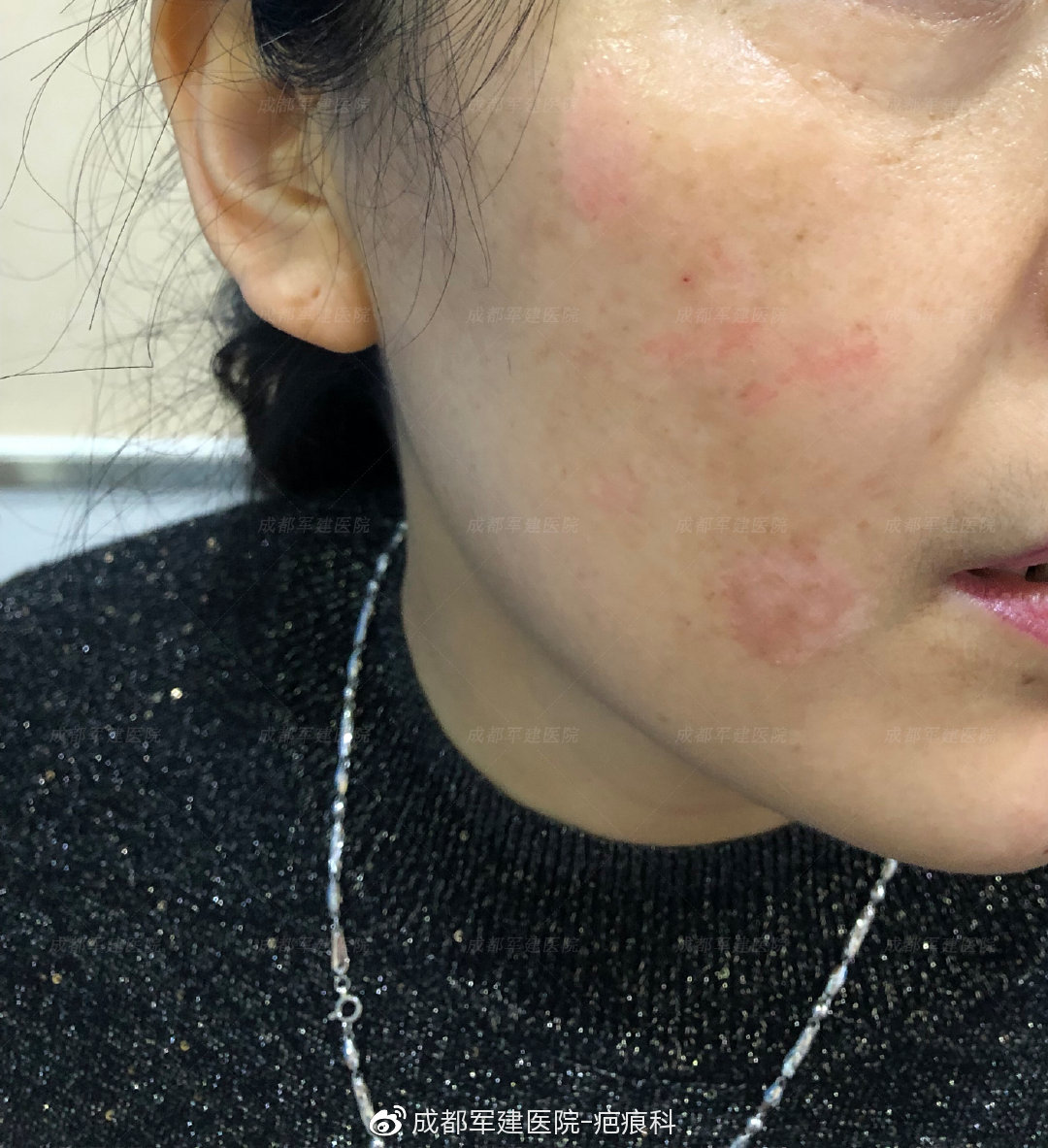 疤痕体质烫伤疤痕什么样,治疗烫伤疤痕小妙方