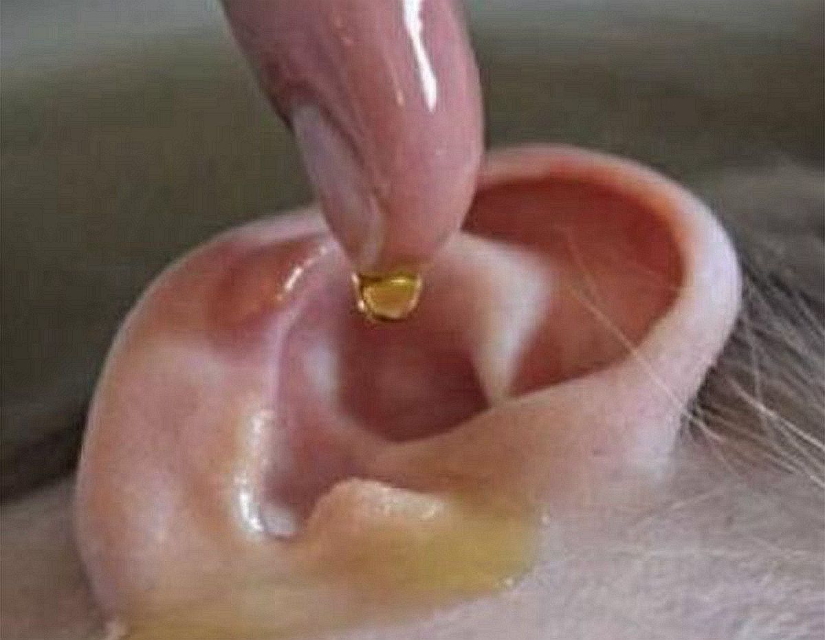 孩子耳朵里进虫子处理视频,孩子耳朵里进虫子