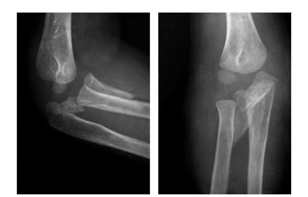 青少年肘部损伤最常见的是,肘部桡神经损伤的临床表现