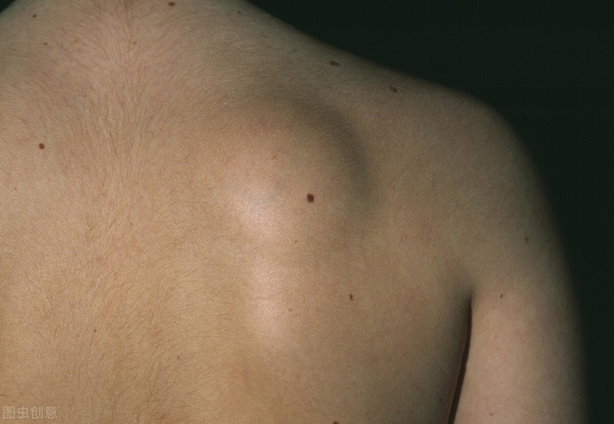 长脂肪瘤是什么引起的,脂肪瘤有什么危害脂肪瘤最怕什么