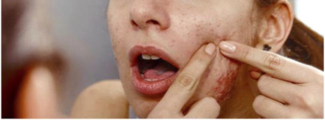 皮肤粗糙毛孔粗大自愈,毛孔粗大毛孔里都是白的