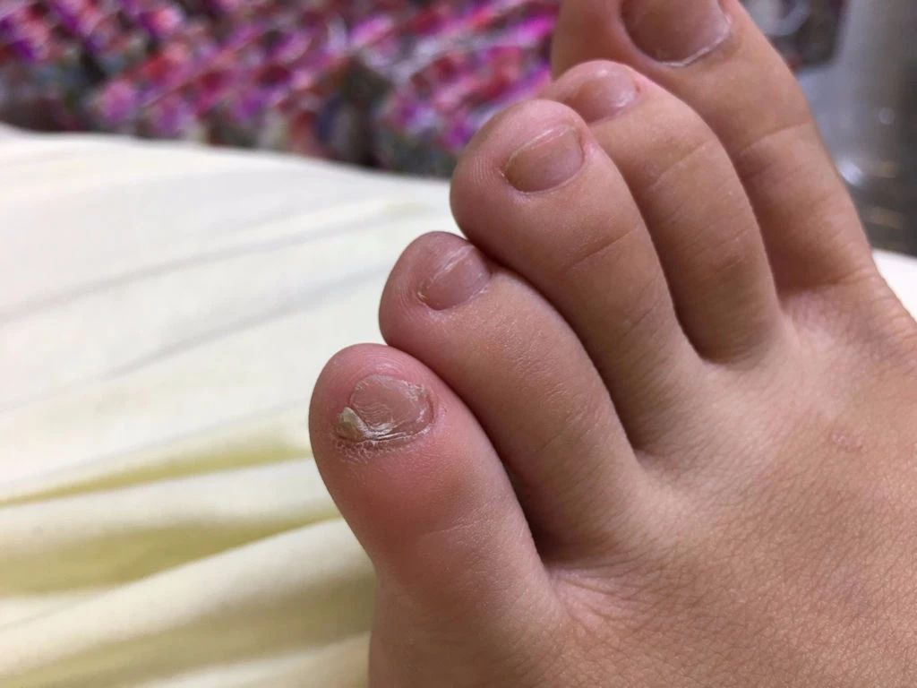 新生儿青色皮肤是不是胎记,新生儿青斑是中国人才有的吗