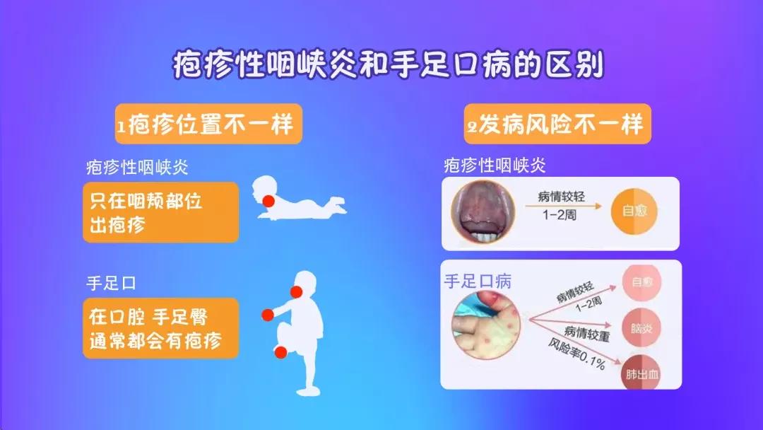 疱疹性咽峡炎阶段详解,疱疹性咽峡炎开始到结束的图片