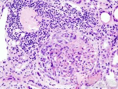 狼疮性肾炎和狼疮性肾损害的区别,狼疮性肾炎饮食注意事项