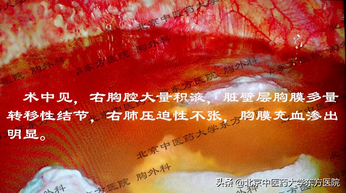 北京治疗胸腔积液哪个医院权威,中医治疗心脏胸腔积液