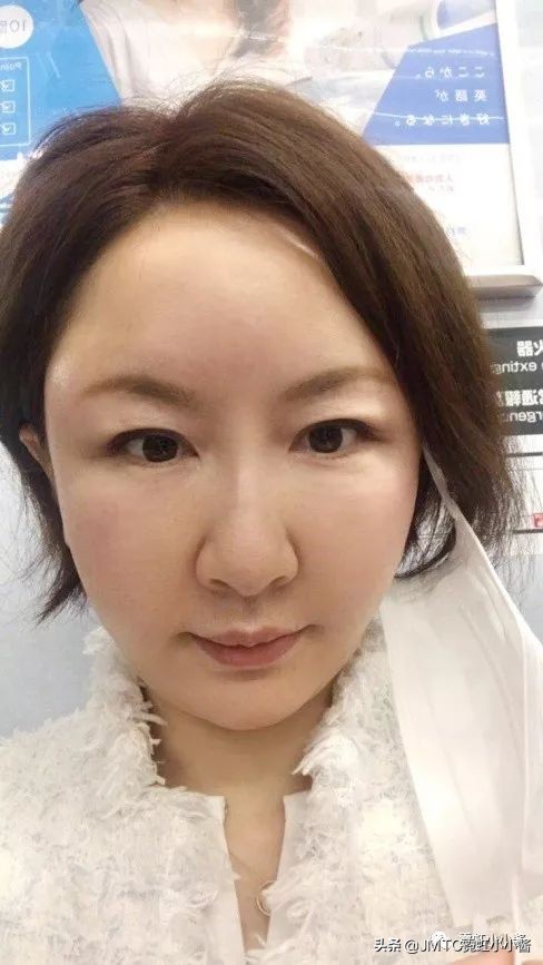 记录翻译小姐姐日本打溶脂针,肉脸变骨感脸全过程|日本医美