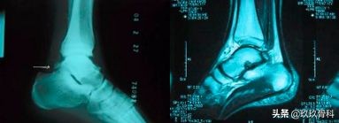 陈旧性踝关节损伤的治疗,踝关节损伤现场处理视频