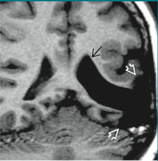 各种囊肿的症状,颅内囊肿18-19mm严重吗