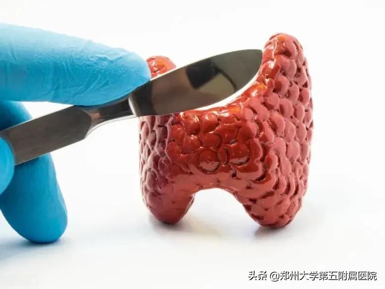 喝了131碘以后就胖了,碘131后有瘦下来的吗