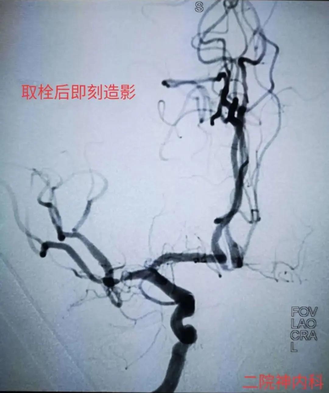 经皮颅内动脉取栓术全过程,为患者打开生命希望之门