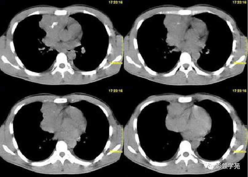 纵隔和肾上腺恶性肿瘤,纵隔性肿瘤位置图