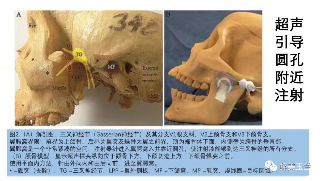 病例分享丨三叉神经节微球囊压迫术的麻醉管理