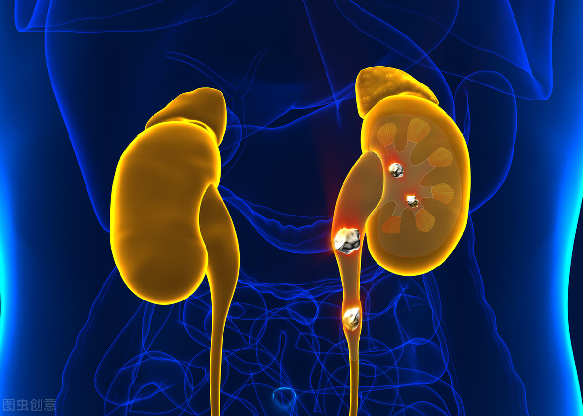 右肾结石115x63mm严重吗,右肾结石56毫米怎么办