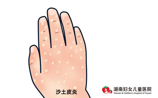 儿童身上皮疹反反复复怎么办,全身皮疹怎样止痒