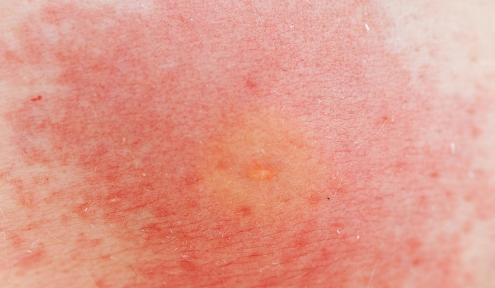 脸颊敏感红干怎么护肤,脸上敏感有红血丝怎么修复