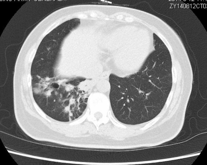 黏液腺癌基本不转移不复发,肺粘液腺癌转移了还能治好吗