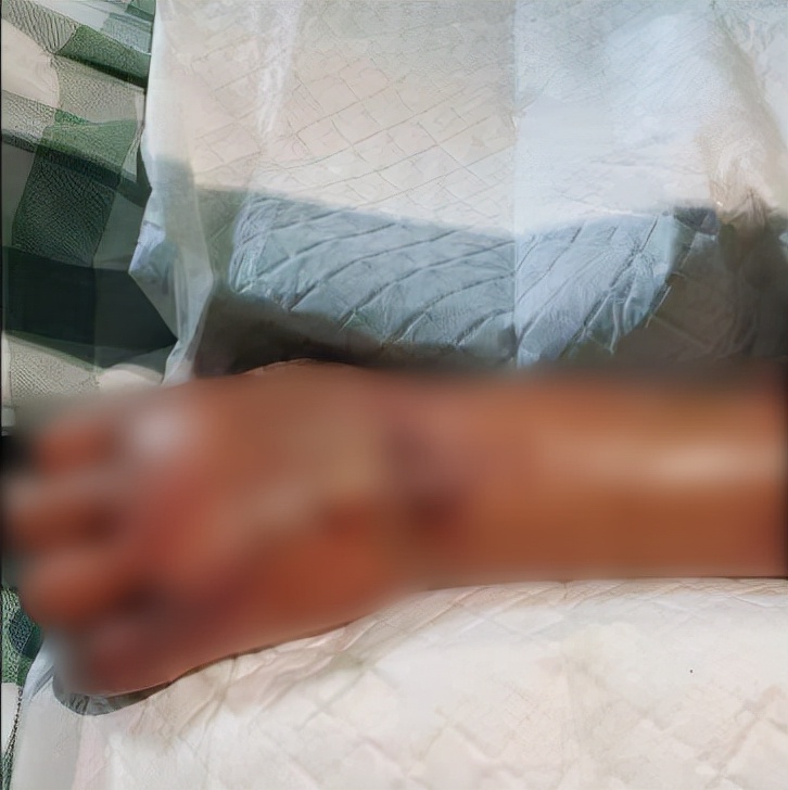 洗虾扎伤手老人被迫截肢保命,老人洗虾手指遭刺保命