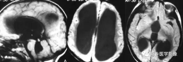 脑室为什么会扩张,脑室为什么会变小