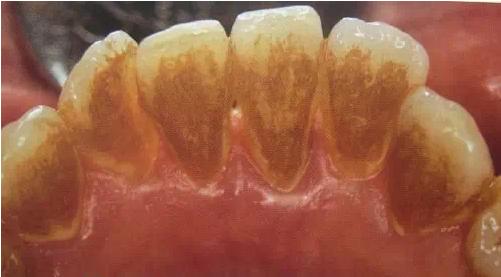 洗牙去除异物吗,洗牙怎样才不伤牙齿