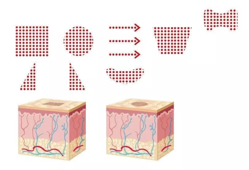 点阵激光打到正常皮肤会怎么样,激光点阵能给皮肤带来什么效果