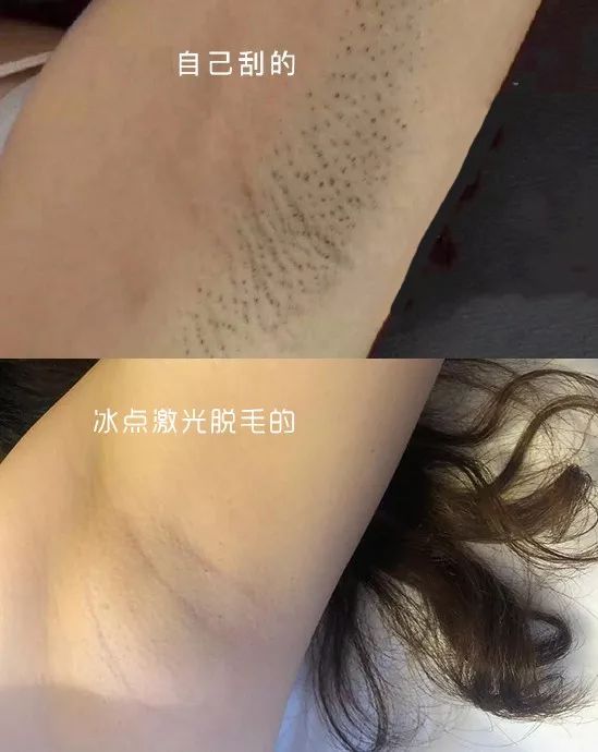 脱毛的正确方法推荐,简单又有效的脱毛小技巧