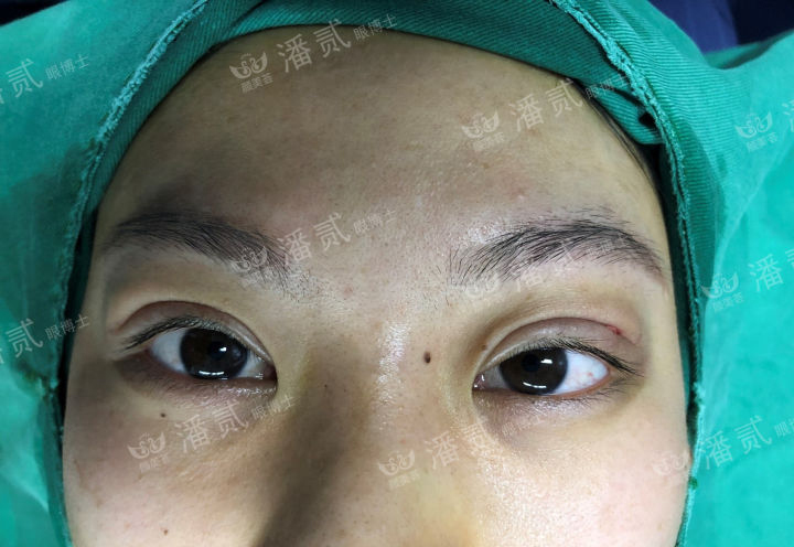 肿眼泡抽脂肪埋线双眼皮效果,肿眼泡割双眼皮长脂肪