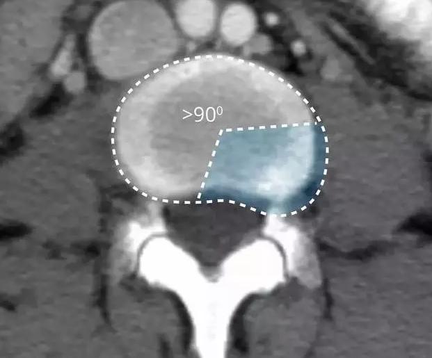 腰椎间盘的膨出和突出有什么区别,腰椎间盘突出膨出骨质增生怎么治