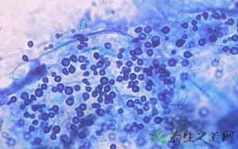 头螨脱发与脂溢性皮炎脱发的区别,脂溢性脱发是脂溢性皮炎引起的吗