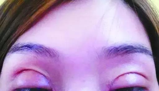 双眼皮修复为什么更贵,双眼皮修复是怎么做的