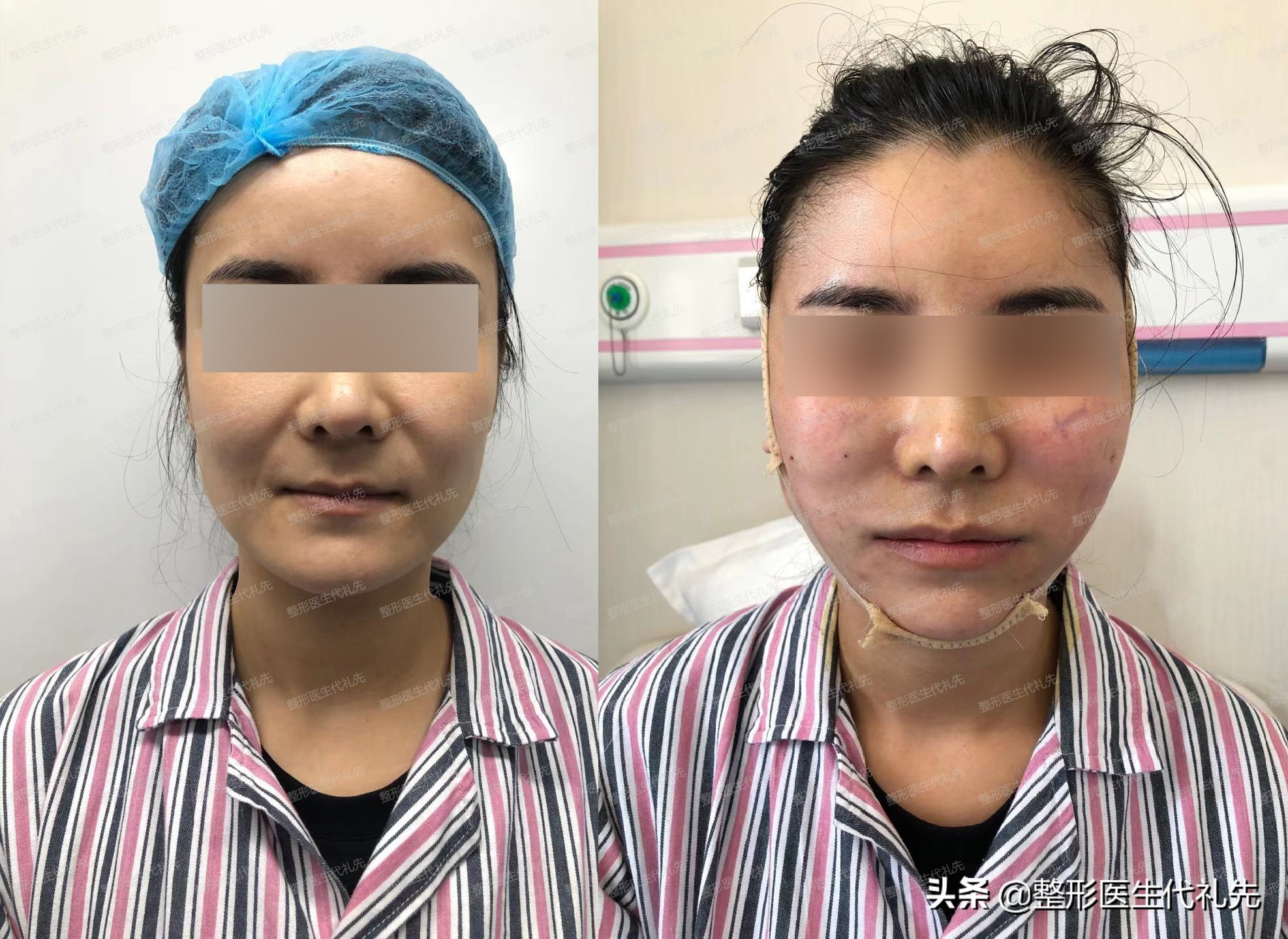 面部提升去皱最有效的方法,全脸提升去皱