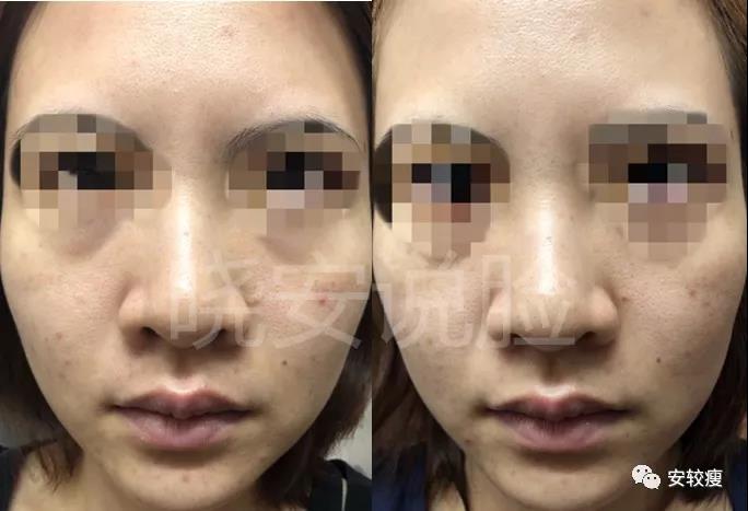 外油内干敏感痘肌怎么护肤,30岁油皮痘痘敏感肌怎么改善