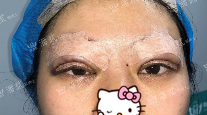 肿眼泡抽脂肪埋线双眼皮效果,肿眼泡割双眼皮长脂肪