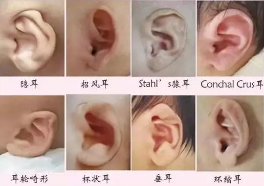 余文林博士耳朵畸形,余文林小耳畸形再造