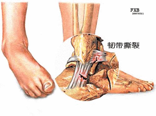 跑步最常见的十种伤痛及处理方法,跑步相关运动损伤综述