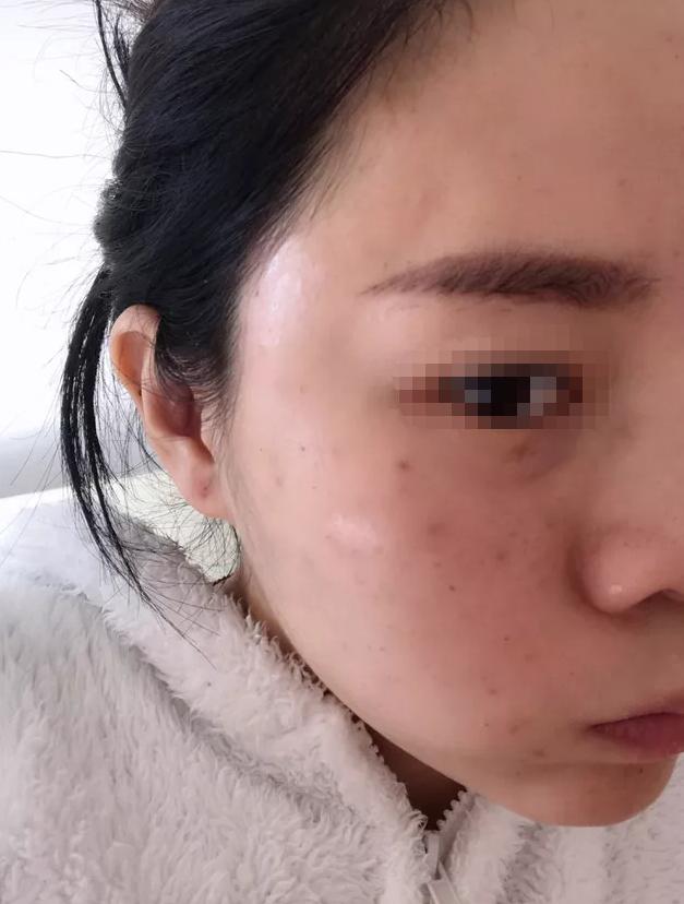 水光针是什么打了有什么作用,水光针如果停了会有什么影响