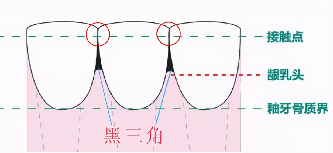 牙齿为什么会黑三角,牙齿出现黑三角是为什么