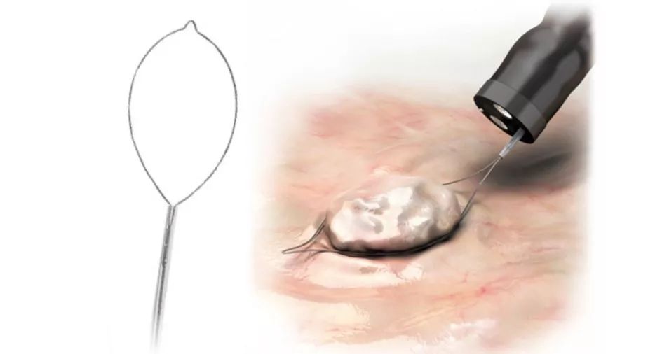 emr和esd消化内镜哪个好,内镜下esd和emr治疗的区别