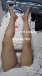 新冠引起静脉血栓怎么治疗,静脉血栓是新冠高危人群吗