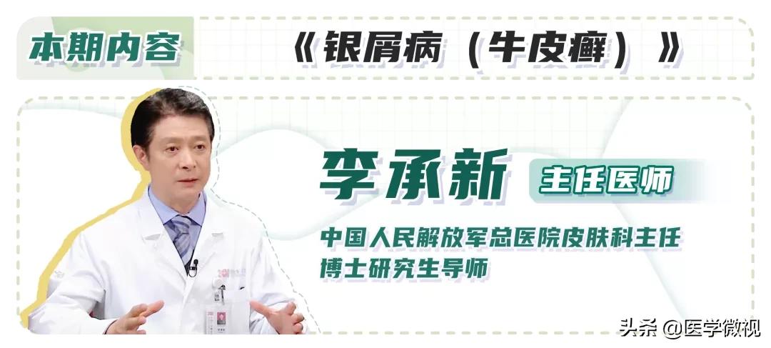 牛皮癣鳞屑怎么治疗,牛皮癣皮肤痒治疗最快的方法