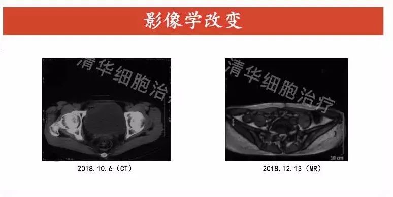卵巢癌术后需要几次化疗,卵巢癌先化疗三次再手术效果好吗