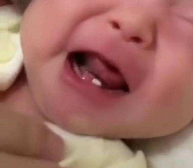 婴儿出生自带的牙齿,有些宝宝一出生就有牙齿