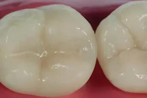 补牙4年后钻心的痛怎么回事,补牙一两年后出现疼痛什么原因