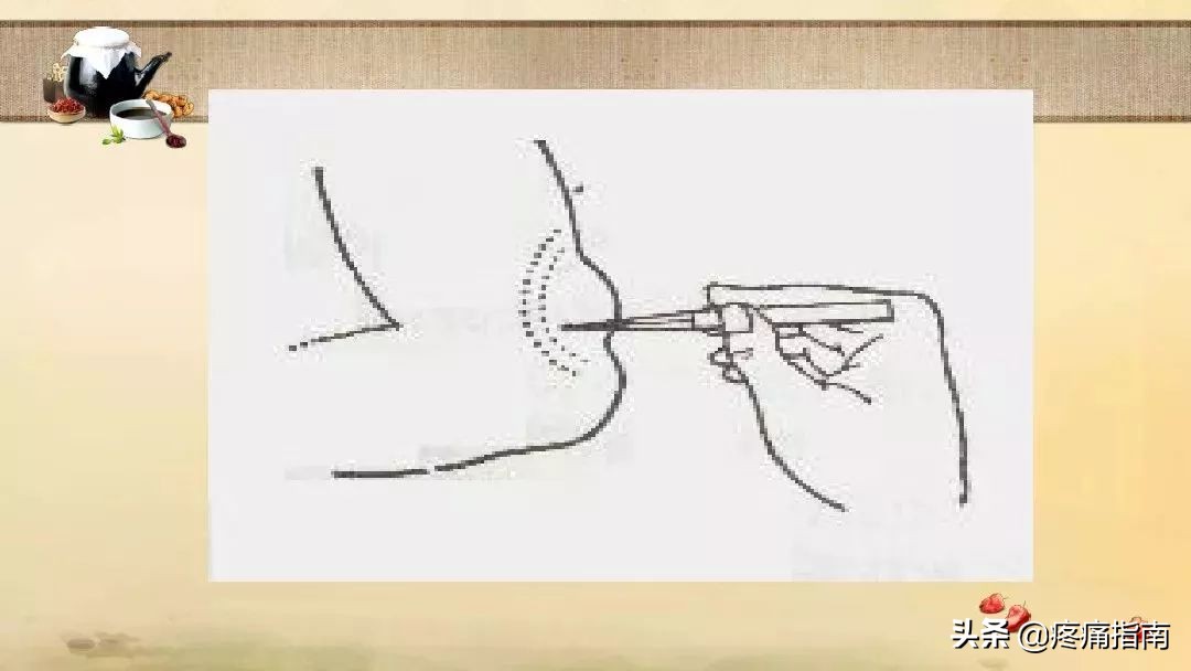 中医刺络放血疗法,中医刺络放血