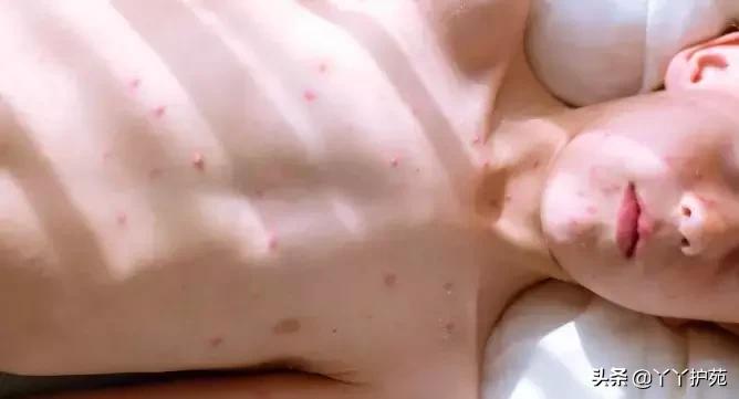 儿科常见出疹性疾病,儿科常见出疹性疾病有哪些