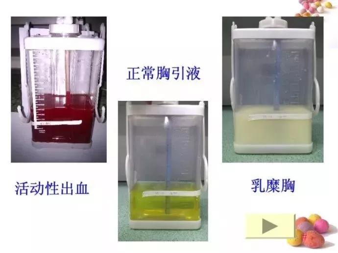护士观察瞳孔注意事项,胸腔闭式引流的护理及注意事项