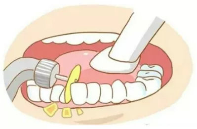 矫正拔牙全过程真实记录,拔牙后悔了不想矫正了怎么补救
