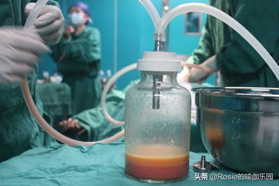 抽脂瘦肚子管用吗,抽脂瘦大腿瘦胳膊会反弹吗