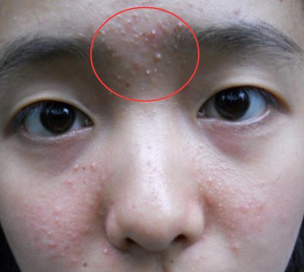 *疮痤**的治疗用药，请收藏